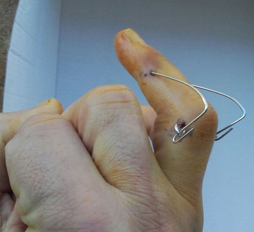 Sintético 92+ Foto como enderezar un dedo torcido de la mano Lleno